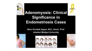 Adenomyosis, 2nd European Congress On Endometriosis, November 2013, Berlin 3