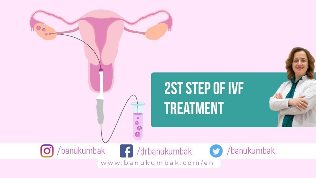 2nd Step of IVF Treatment: Oocyte Pıck-Up (OPU)-Banu Kumbak Aygun, M.D., Professor