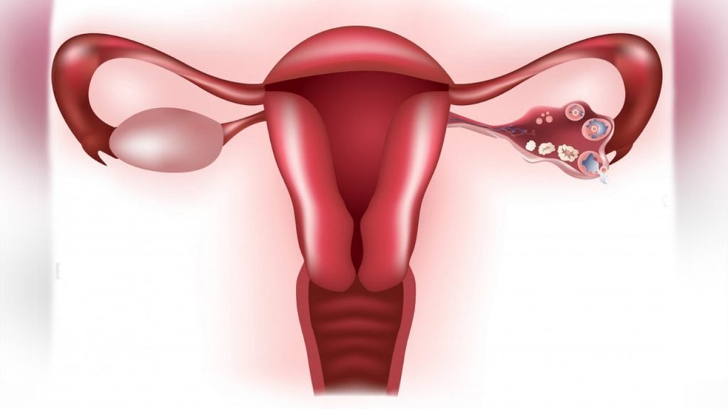 WHAT IS ENDOMETRIOSIS? ENDOMETRIOSIS WITH ALL ASPECTS