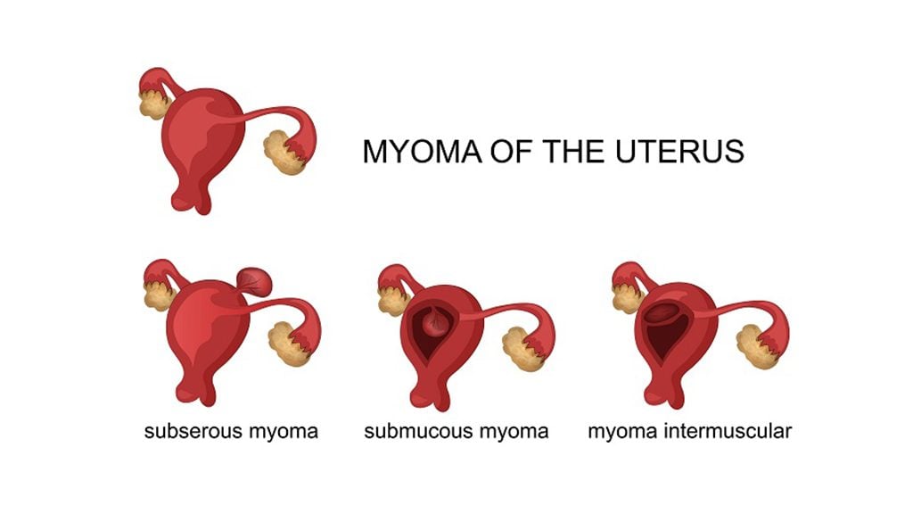 DOES UTERINE MYOMA CAUSE INFERTILITY?  SHOULD EVERY MYOMA BE OPERATED ON? AND WHEN SHOULD IT BE OPERATED?