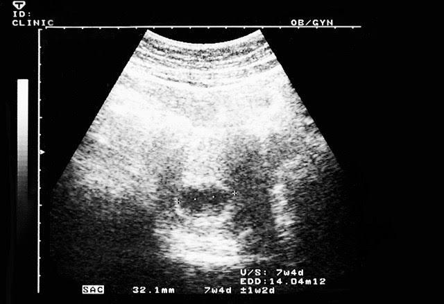 Gebelikte 7. haftada anne karnında ki bebeğin ultrason görüntüleri